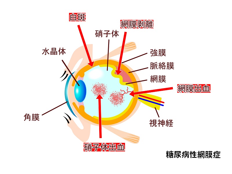 糖尿病網膜症の手術は効果がありますか?