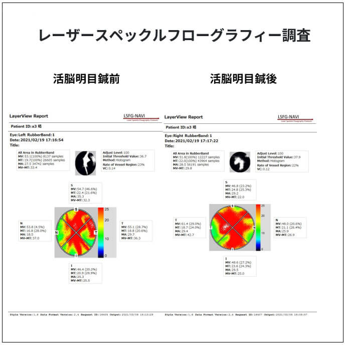 レーザースペックルフローグラフィー調査